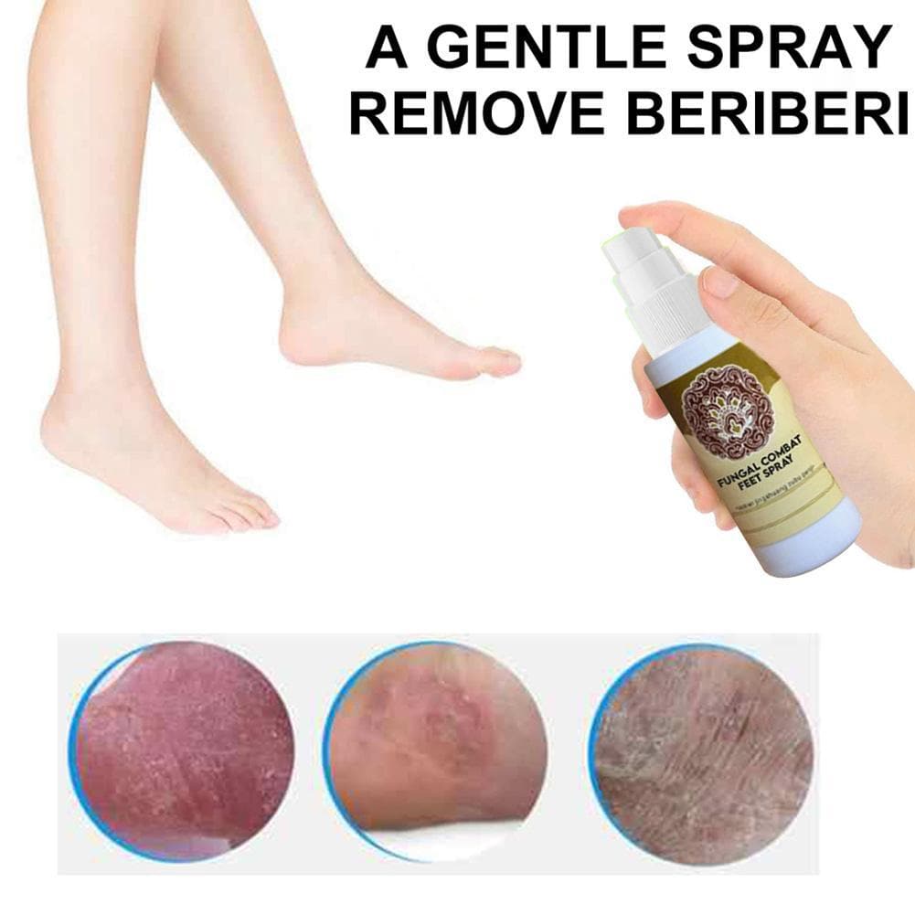 Fungal Treatment Foot Spray - Beauty And Personal Care - DINIBLO 