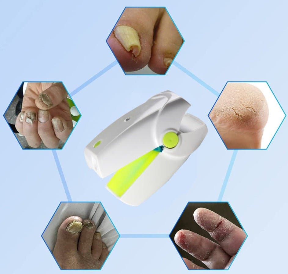 Portable Fungus Nail Laser - Nail Care - DINIBLO 