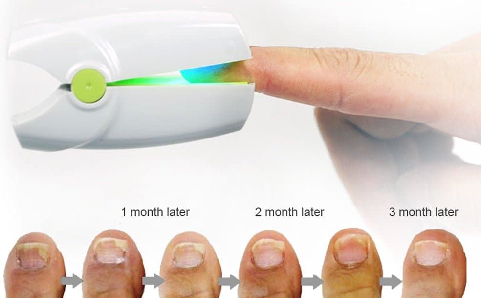 Portable Fungus Nail Laser - Nail Care - DINIBLO 