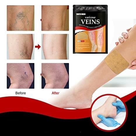 Varicose Veins Treatment Patch - Skin Care Masks & Peels - DINIBLO 